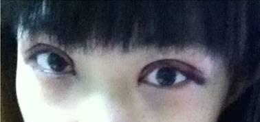 韓式三點雙眼皮是永久嗎？三點雙眼皮能保持多久？