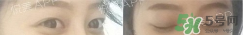 埋線雙眼皮多久恢復(fù)自然？埋線雙眼皮多久能恢復(fù)