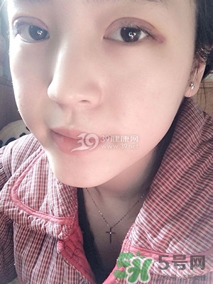 什么是定點雙眼皮？定點雙眼皮多少錢？