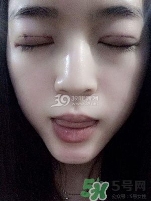 什么是定點雙眼皮？定點雙眼皮多少錢？