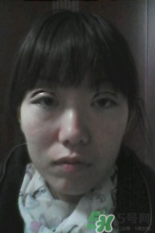 什么是定點雙眼皮？定點雙眼皮多少錢？