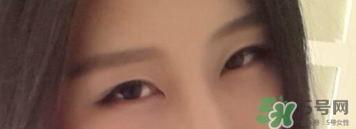 切開(kāi)雙眼皮多久消腫？切開(kāi)雙眼皮多久恢復(fù)？