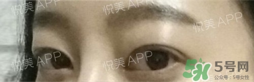 埋線雙眼皮多久恢復(fù)自然？埋線雙眼皮多久能恢復(fù)