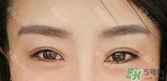 埋線雙眼皮能保持多久？埋線雙眼皮是永久嗎