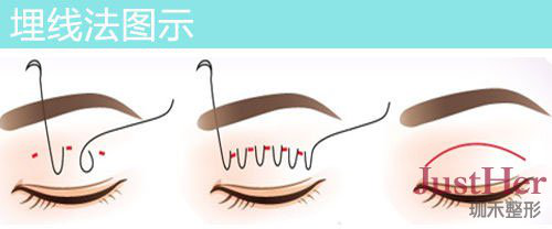 定點(diǎn)雙眼皮怎么做？定點(diǎn)雙眼皮需要拆線嗎？