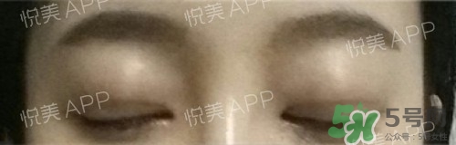 埋線雙眼皮多久恢復(fù)自然？埋線雙眼皮多久能恢復(fù)
