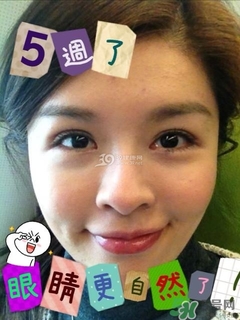 重瞼術(shù)是什么？重瞼術(shù)是永久的嗎？