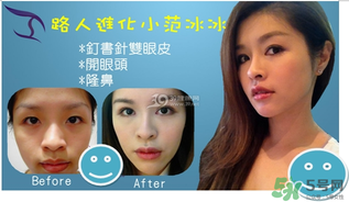 重瞼術(shù)是什么？重瞼術(shù)是永久的嗎？