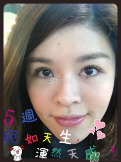 重瞼術(shù)是什么？重瞼術(shù)是永久的嗎？