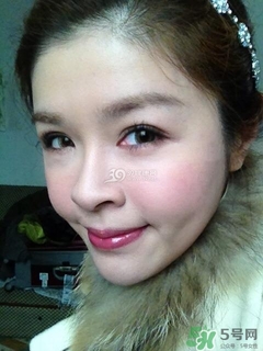 重瞼術(shù)是什么？重瞼術(shù)是永久的嗎？