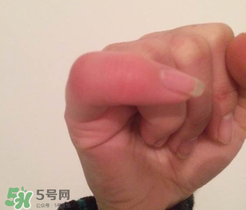 小拇指凍腫了怎么辦？為什么小拇指容易凍？