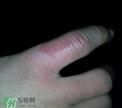 小拇指凍腫了怎么辦？為什么小拇指容易凍？