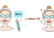 咬肌會(huì)改變臉型嗎？切除咬肌會(huì)改變臉型嗎？