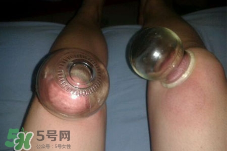 拔罐瘦腿真的有效嗎？腿部拔火罐減肥效果好嗎？