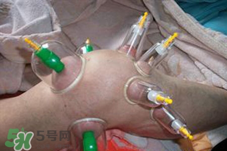 小腿能拔罐嗎？在小腿上拔火罐有什么作用？