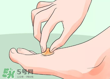 水泡怎么處理？水泡要不要刺破？