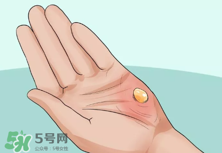 水泡怎么處理？水泡要不要刺破？