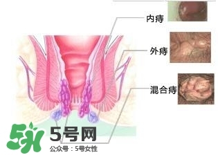痔瘡吃什么藥效果好？痔瘡吃什么藥好得快？