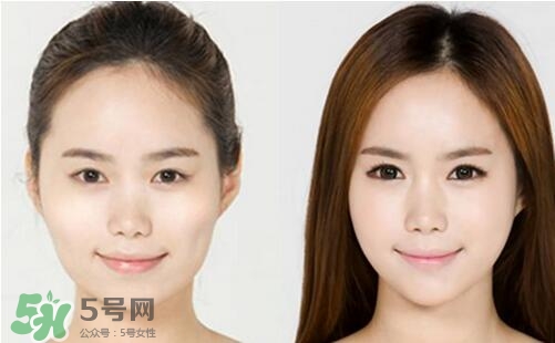 瘦臉針分為幾種類型？瘦臉針有哪幾個牌子？