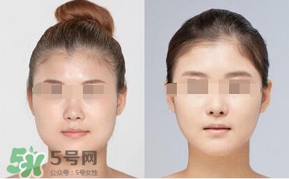 瘦臉針分為幾種類型？瘦臉針有哪幾個牌子？