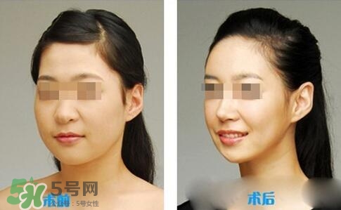 瘦臉針分為幾種類型？瘦臉針有哪幾個牌子？