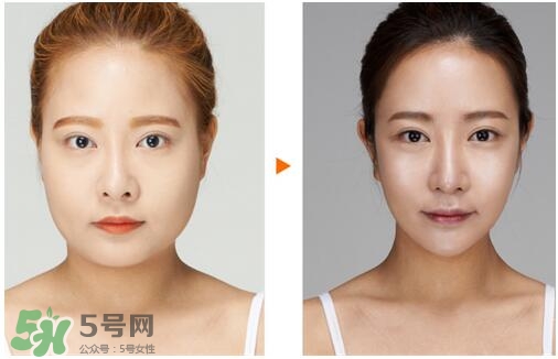 瘦臉針分為幾種類型？瘦臉針有哪幾個牌子？