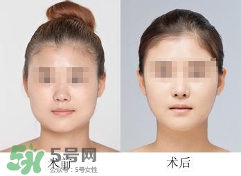 打瘦臉針能喝酒嗎？打瘦臉針能吃海鮮嗎？