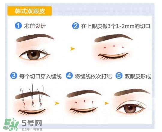 割雙眼皮有幾種做法？雙眼皮有哪幾種形狀？