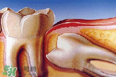 智齒會(huì)引起耳鳴嗎？耳鳴跟智齒有關(guān)系嗎？
