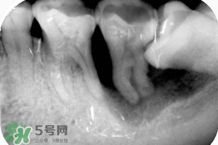 智齒會(huì)引起耳鳴嗎？耳鳴跟智齒有關(guān)系嗎？
