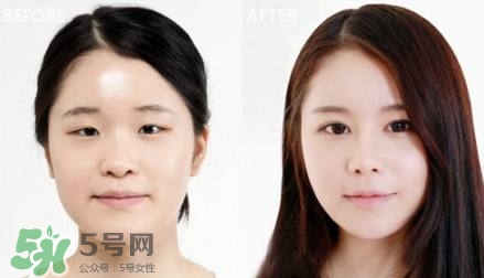 割雙眼皮有什么后遺癥嗎？割雙眼皮有什么危害性？