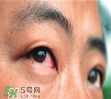 紅眼病是怎么引起的？紅眼病怎么產(chǎn)生的