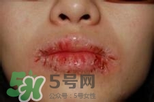 嘴唇干燥是什么原因？嘴唇干裂脫皮怎么辦？