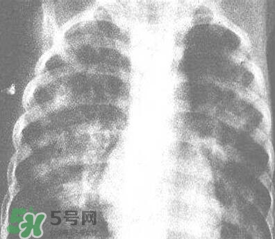 紅眼病是怎么引起的？紅眼病怎么產(chǎn)生的