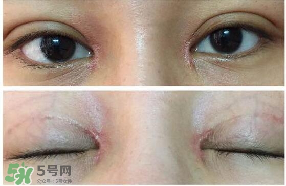 眼角增生是什么意思？眼角增生了怎么辦？
