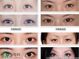 哪些人需要開眼角？需要開眼角的眼睛圖片