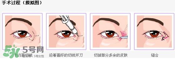 哪些人需要開眼角？需要開眼角的眼睛圖片