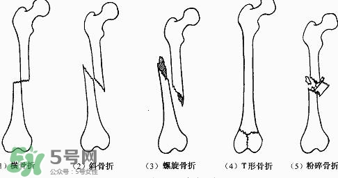 骨折吃什么好得快？骨折后注意事項