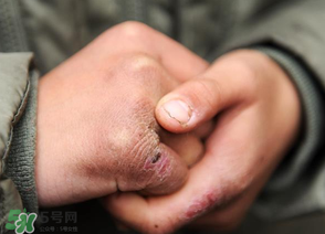 三月份還長(zhǎng)凍瘡嗎？三月份凍瘡沒(méi)好怎么辦？