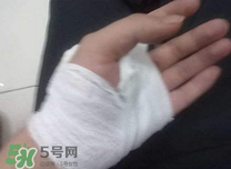 傷口化膿怎么處理？傷口化膿用什么藥好？