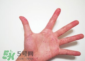 切辣椒后手很辣怎么辦？切辣椒后手很辣多久能好