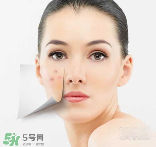 黑色痘印多久會(huì)消失？黑色痘印消失時(shí)間