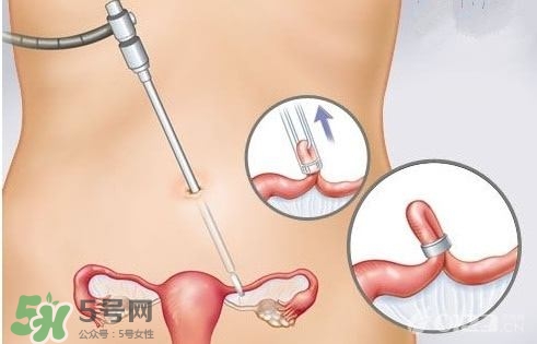 女人怎樣避孕最安全？對女人最好的避孕方法