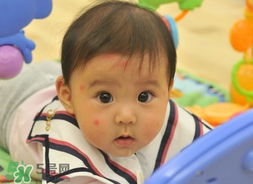 嬰兒被蚊子咬了如何去紅點(diǎn)？被蚊子咬后紅點(diǎn)如何去除？