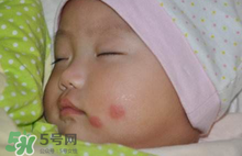 嬰兒被蚊子咬了如何去紅點(diǎn)？被蚊子咬后紅點(diǎn)如何去除？
