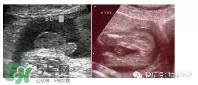 B超單數(shù)據(jù)怎么看男女？B超單看男女準(zhǔn)嗎？