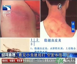 隱翅蟲有毒嗎？隱翅蟲會毀容嗎？