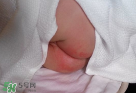 尿布疹怎么辦？寶寶尿布疹擦什么藥好？