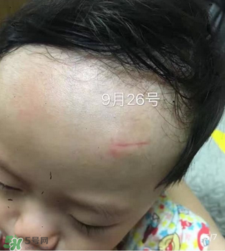 日本msd祛疤膏是抗生素嗎？日本msd祛疤膏是不是抗生素？