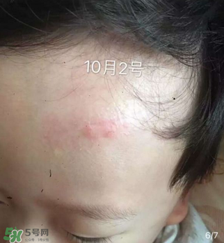 日本msd祛疤膏是抗生素嗎？日本msd祛疤膏是不是抗生素？